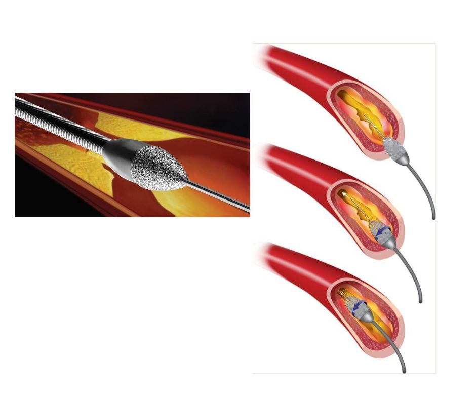 Best Cardiologist in Jaipur (#1 Heart Specialist) - Dr. Prashant Dwivedi