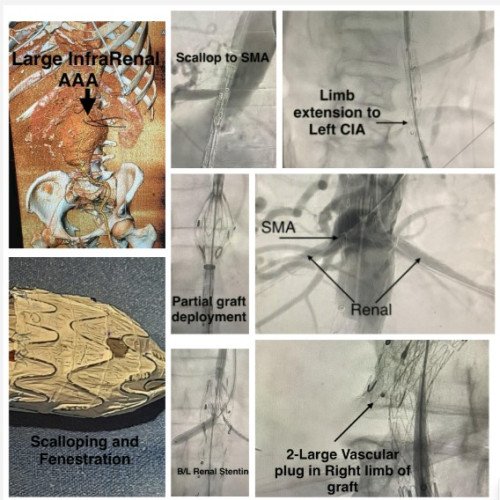 A very complex EVAR procedure in Large infrarenal AAA