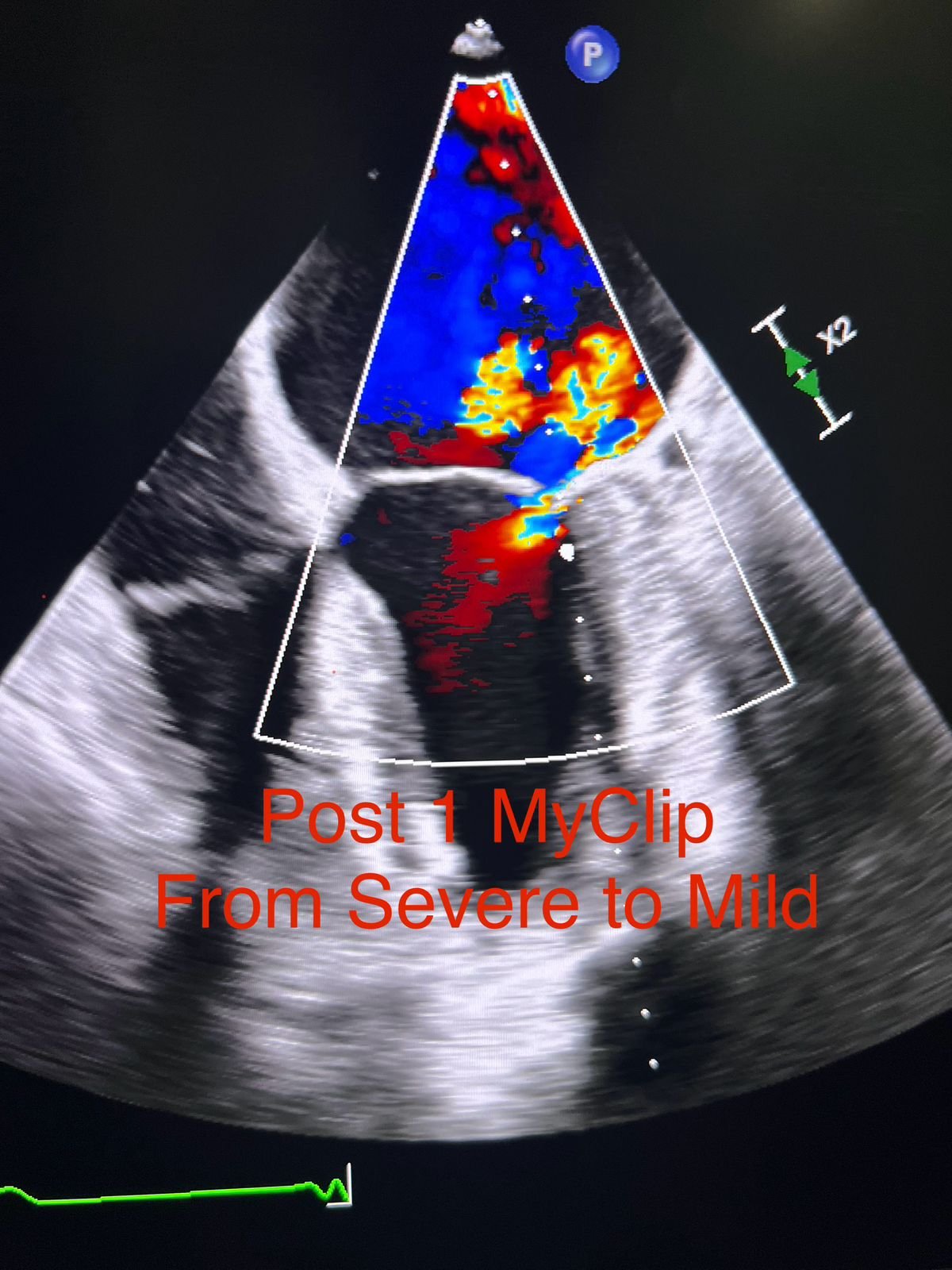 Shahar ke Eternal Hospital mein ek hi din mein hua heart ke mitral valve ke ilaj ka tarantaar procedure