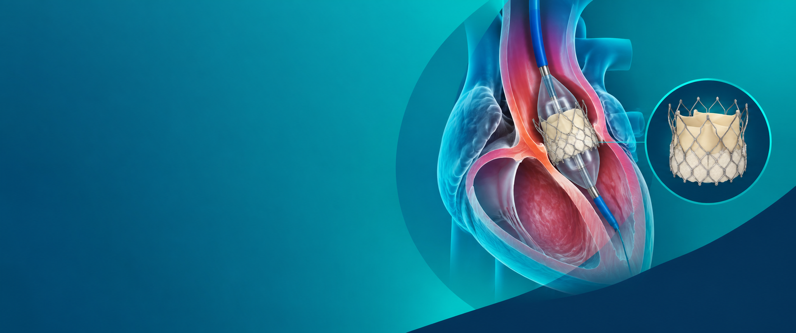Transcatheter Aortic Valve Replacement (TAVR / TAVI)